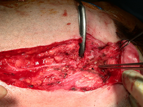 Retrograde Dissection of Facial Nerve