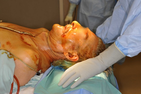 This patient underwent tracheotomy prior to prep/drape for resection and reconstruction