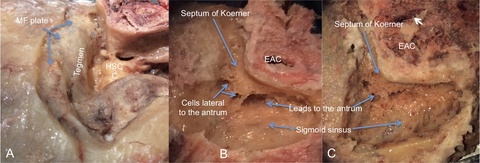 Superior dissection (Figure 2 A, B and C)