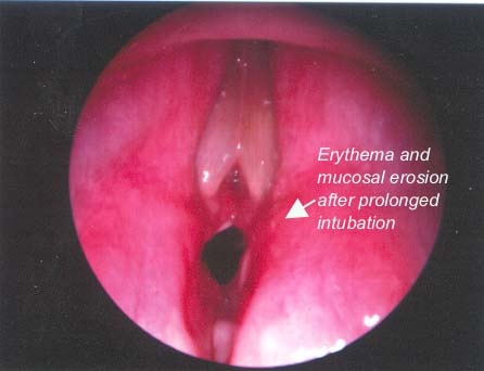 Another case showing appearance of posterior glottis immediately after extubation:
