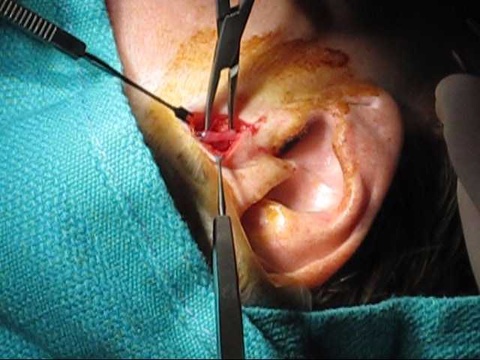 *Biopsy Photo is NOT intended for instructional purposes, only for completeness in case report. For instruction, see 'Temporal Artery Biopsy' in Temporal Arteritis aka Giant Cell Arteritis and Temporal Artery Biopsy Technique