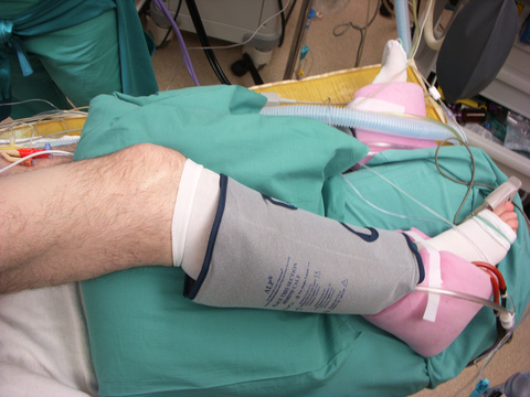 Knees must be properly padded as patient will be turned for flap harvesting.