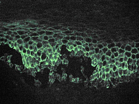 Microscopic image of direct immunofluorescence using an anti-IgG antibody. The tissue is skin from a patient with Pemphigus vulgaris. Note the intercellular IgG deposits in the epidermis and the early intraepidermal vesicle caused by acantholysis.