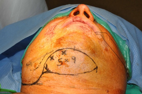 Design of flap around identified cutaneous perforators