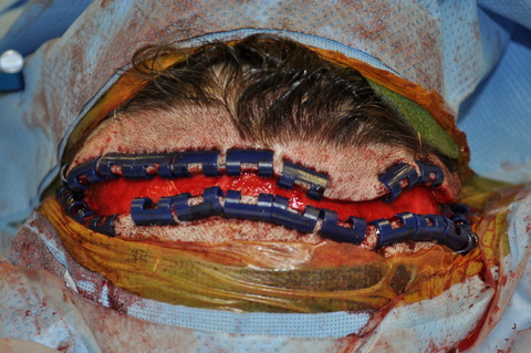 Flap after completion of elevation and lymphadenectomy.  Note careful skeletonization of pedicle in this case of oral cancer