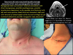 3rd 4th Branchial Cleft Cyst Fistula