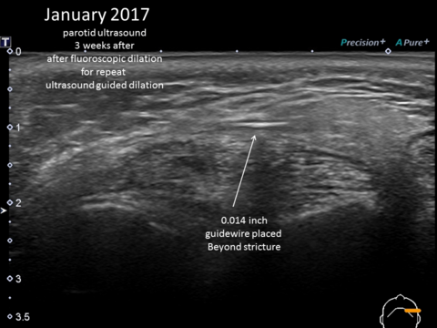 January 2017 3 weeks after fluorscopic dilation, dilation done in clinic with ultrasound