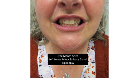 lip biopsy 10