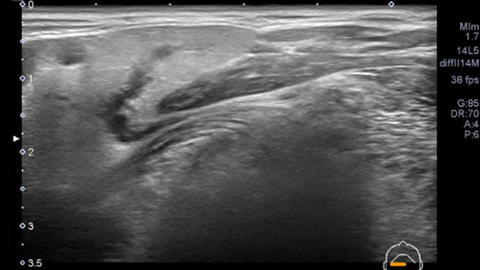 ultrasound and sialogram correlates of submandibular duct obstruction