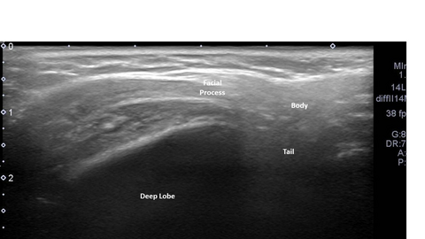 parotid ultrasound standardization
