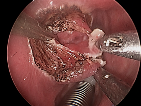 Intraop