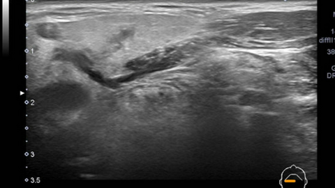 ultrasound and sialogram correlates of submandibular duct obstruction