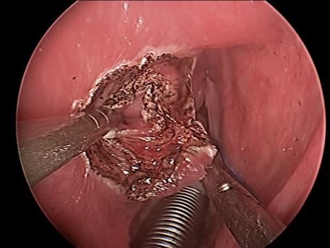 Intraop