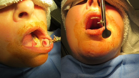 lip biopsy