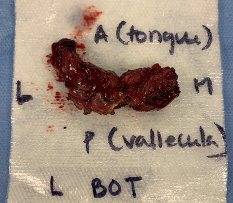 Lingual Tonsillectomy Resection