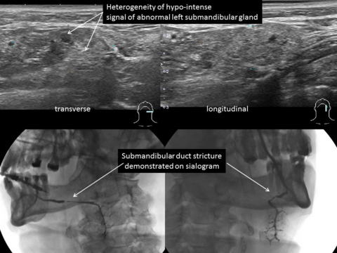 Heterogeneity in submandibular ultrasound identifies and abnormality but not the stricture better seen on sialography