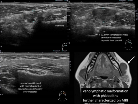 Calcification in venolymphatic malformation misinterpreted as salivary stone on CT