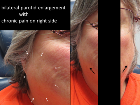 Bilateral parotid enlargement that does not fluctuate. White arrows show right parotid, black arrows bilateral parotid swelling