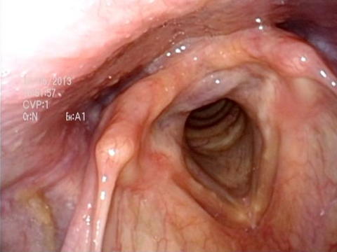 Dec 2013 followup with no voicing or swallowing problems