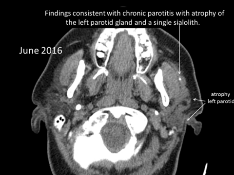 June 2016 CT with stone recurrent left parotid infections s/p previous sialendoscopy