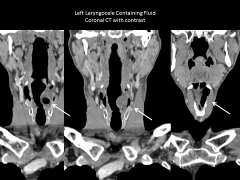 Preop CT