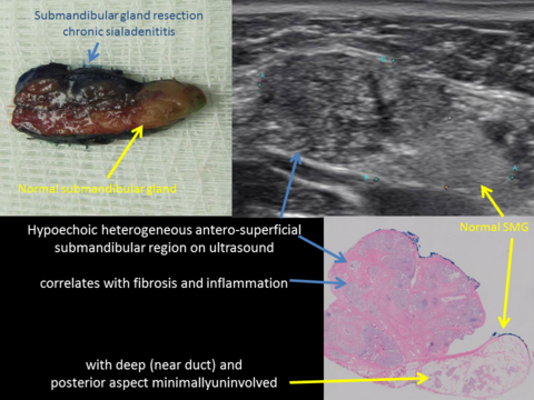 Submandibular gland removed correlates ultrasound images with gross specimen