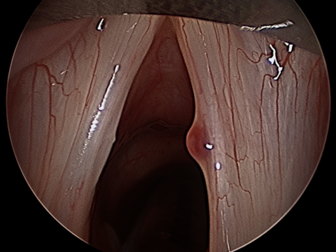 Intraop Microdirect Laryngoscopy with Resection