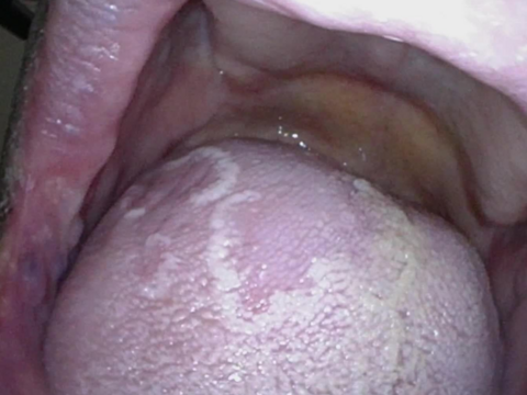 Geographic Tongue