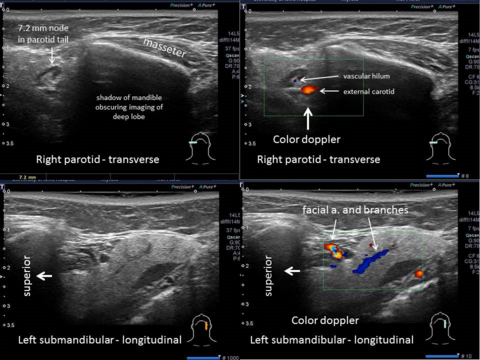 Color doppler aiding in identification of normal vascularity and lymph nodes
