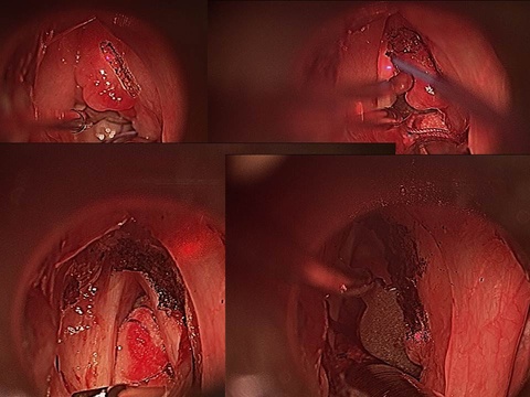 Excision of laryngeal mass
