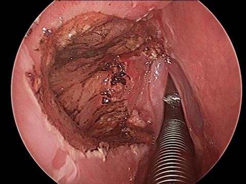 Intraop