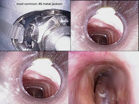 Standard metal #6 Jackson tracheostomy tube in place