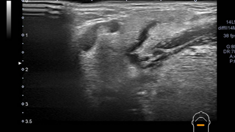 ultrasound and sialogram correlates of submandibular duct obstruction