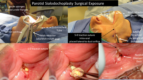 Parotid Sialodochoplasty Surgical Exposure - for Salivary Stone Removal