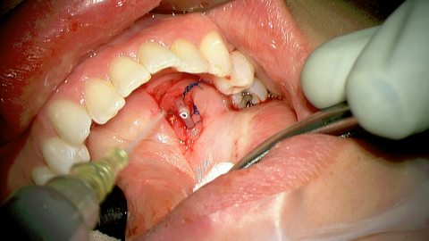Walvekar Salivary Stent