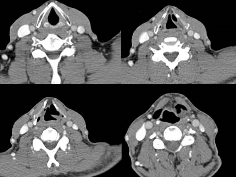 Preop CT