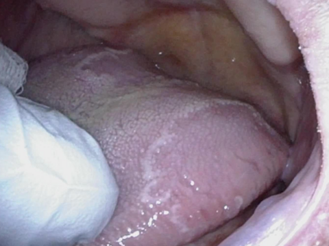 Geographic Tongue