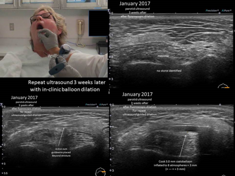 Ultrasound images of guidewire and then dilated sialoballoon in left parotid duct