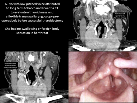 Prominent asymptomatic superior cornu indentations to pharynx
