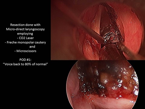 Excision of laryngeal mass