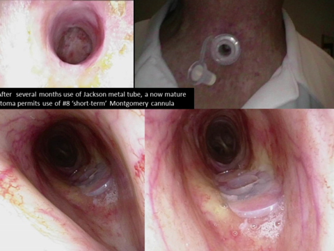 Metal tracheostomy tube replaced with #8 'short term' Montgomery cannula