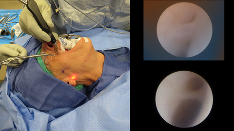 Parotid Sialodochoplasty Surgical Exposure - for Salivary Stone Removal