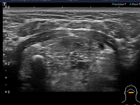 Ultrasound imaging with 14 Mhz probe transverse image of upper anterior neck