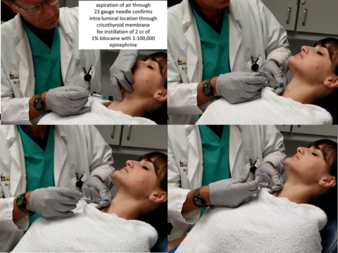 Anesthesia via cricothyroid membrane instillation of lidocaine/epinephrine