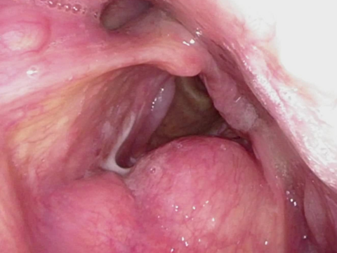 Preop