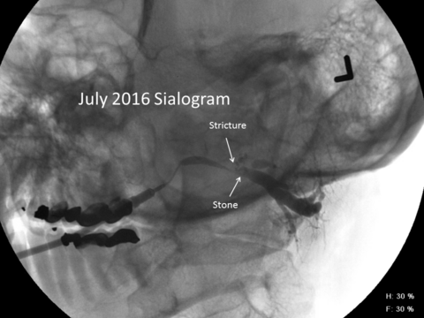 July 2016 sialogram showing a stricture with a stone and dilated duct