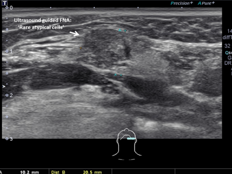 Symptomatic left neck mass FNA biopsy = 'atypical cells'