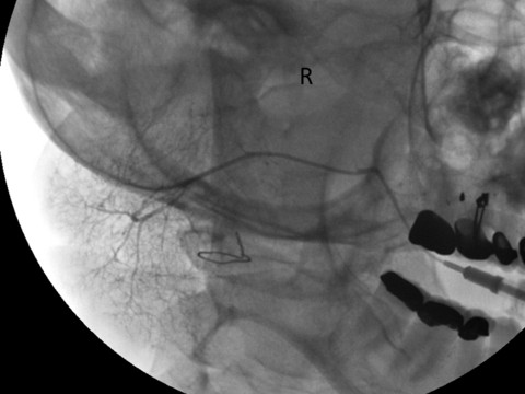 Right parotid sialogram to rule out ductal obstruction showing enlarged gland with splayed appearance to acinar filling c/w sialosis