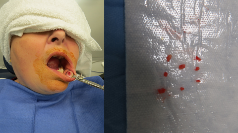 lip biopsy 3