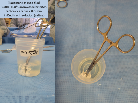 The newly fashioned strip is stored in Bacitracin solution to prepare for implantation